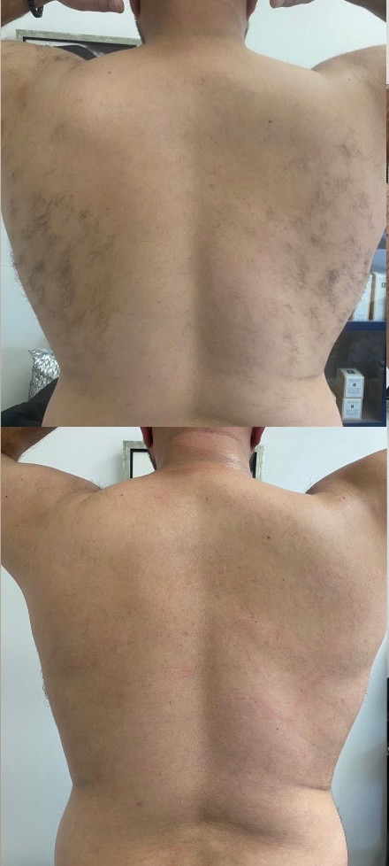 Cack Laser Hair Removal