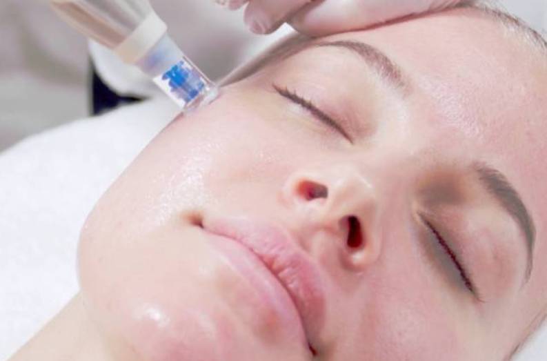 Microneedling Treatment