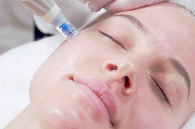 Microneedling Waterloo