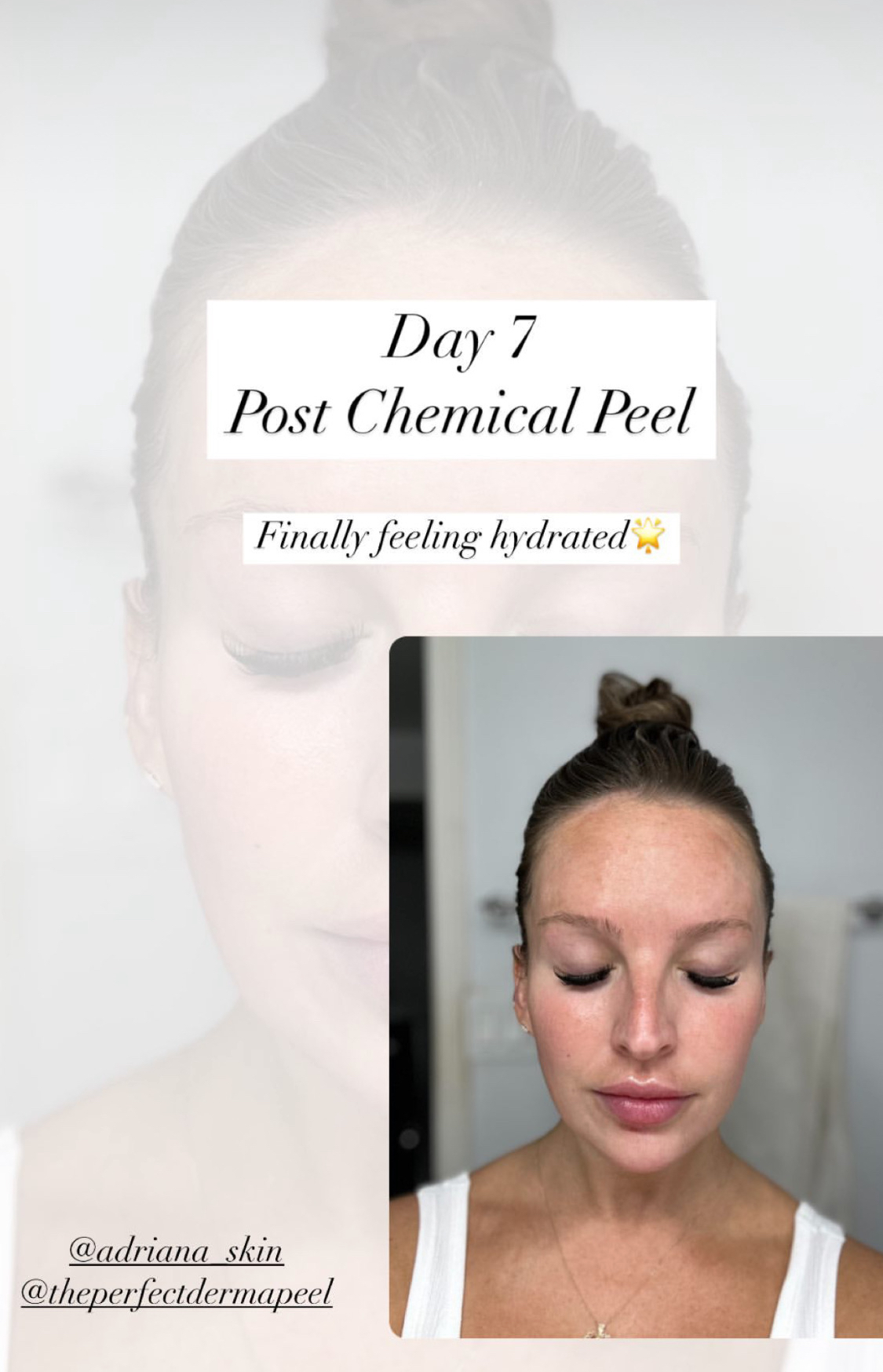 Perfect Derma Chemical Peel